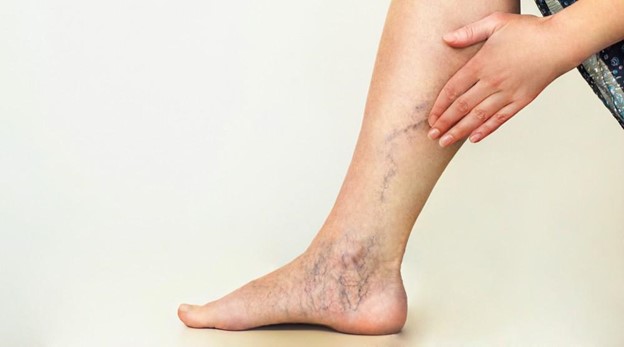 Banish Spider Veins With Sclerotherapy