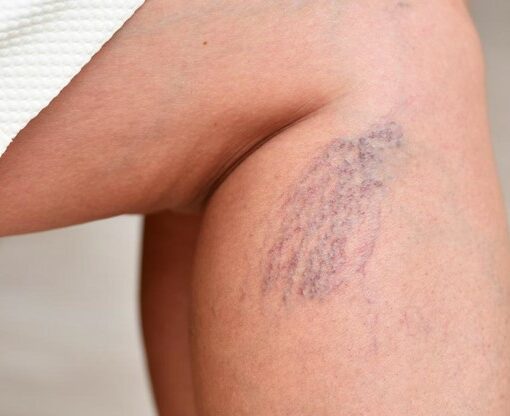 What’s Causing Your Spider Veins?