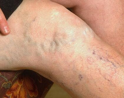 Which Varicose Vein Treatment is Right for You