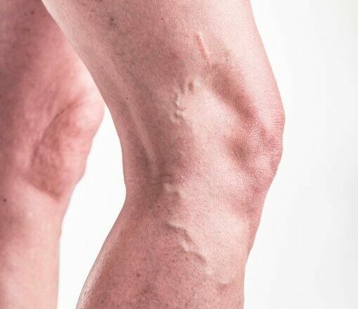 Your Varicose Veins May be More Than Just a Cosmetic Concern