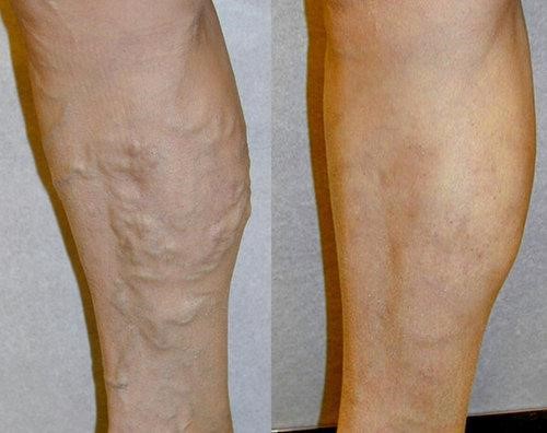 Why Is It Important to Treat Your Varicose Veins? - Vein Specialists of the  Carolinas