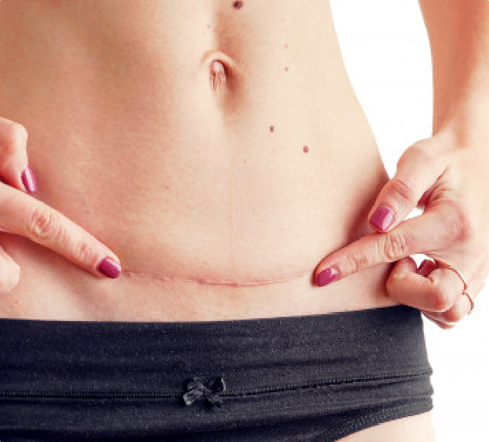 closeup-woman-belly-with-scar-from-cesarean-section-size-isolated_74333-139