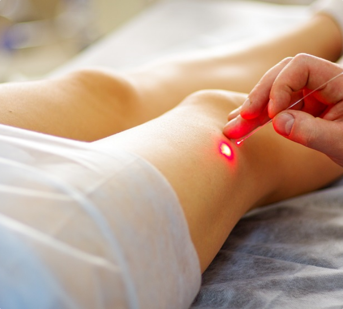 VenaCure Laser Therapy