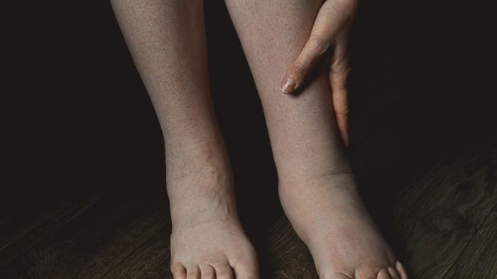 Common Causes of Leg Swelling