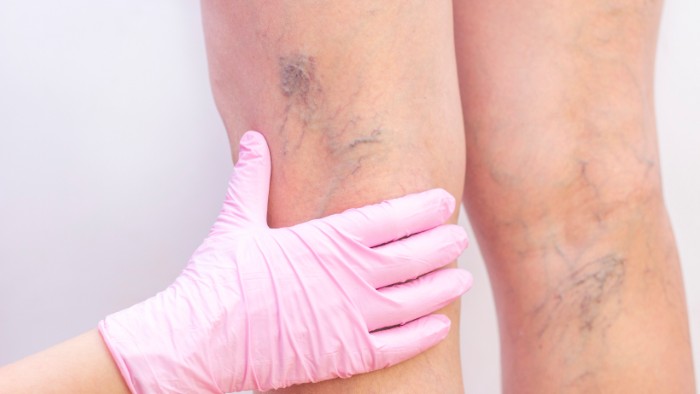 Tips on How to Prevent Varicose Veins