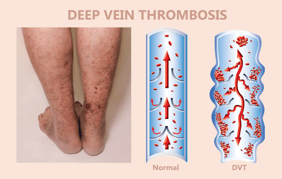 Know the Risks, Signs & Symptoms of Blood Clots