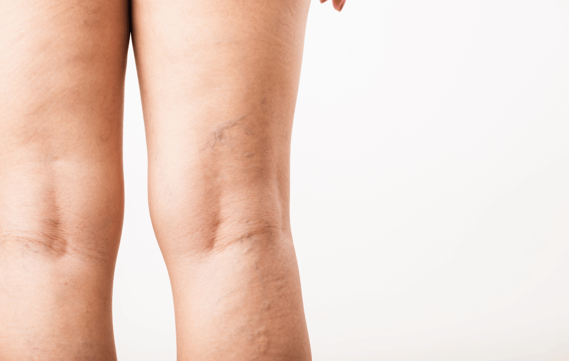 What To Avoid After Sclerotherapy: Post-Treatment Tips