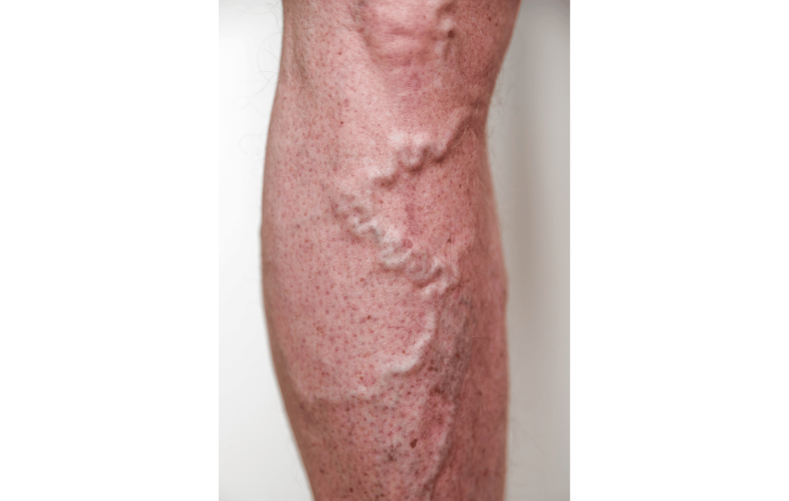 The Causes and Symptoms of a Busted Vein in Your Leg