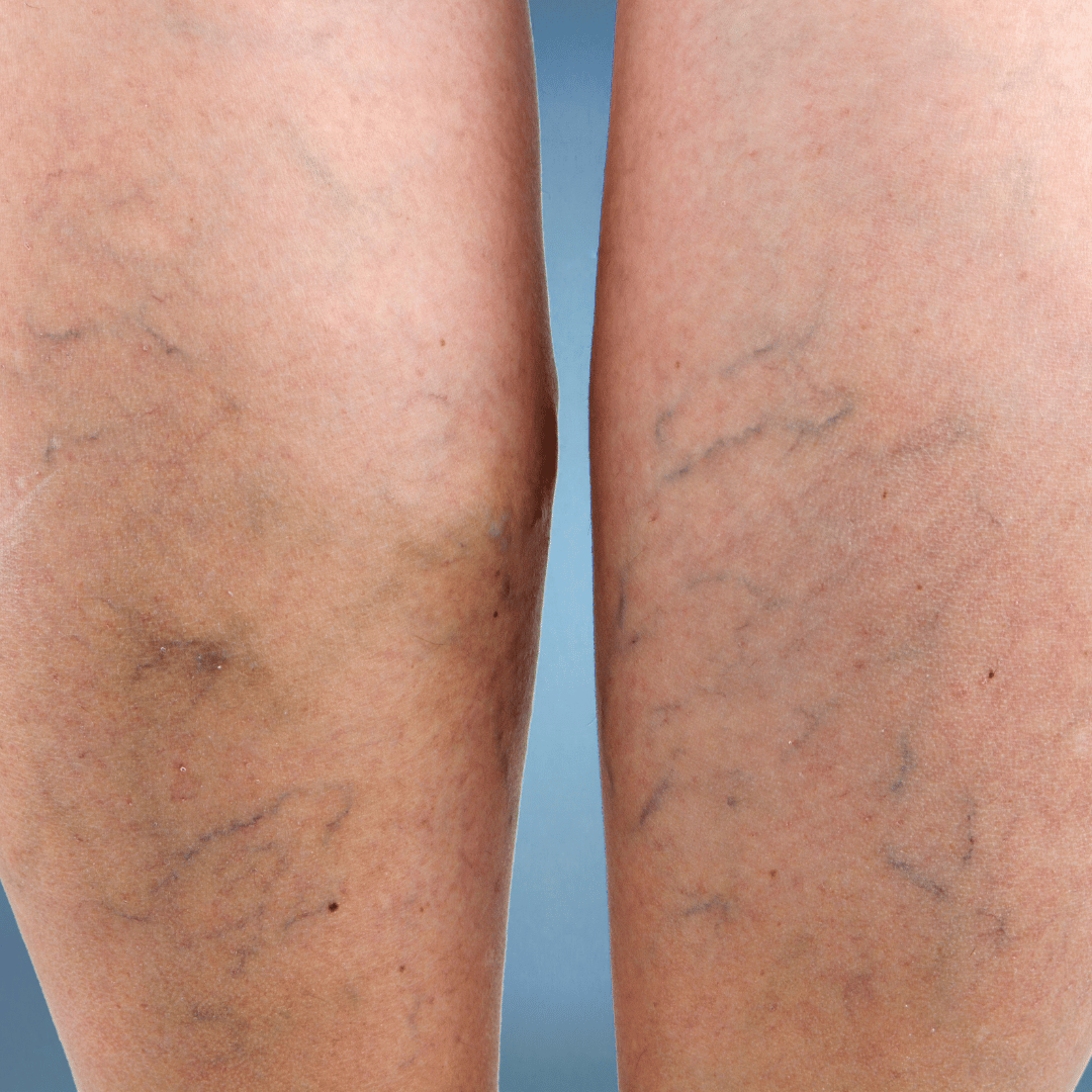 Compression Therapy for Spider Veins Treatment & Prevention