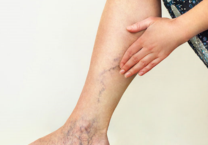 Vein Care near me