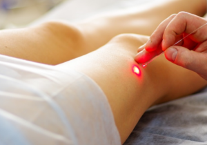 VenaCure Laser Therapy